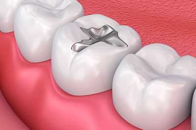 Annadale Amalgam Fillings