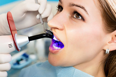 Annadale dental bonding