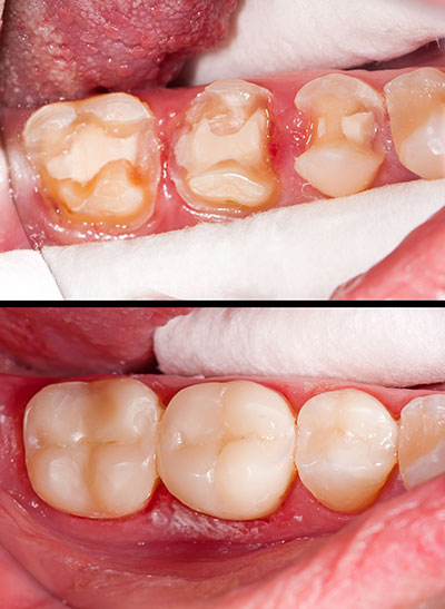 Annadale Composite Fillings