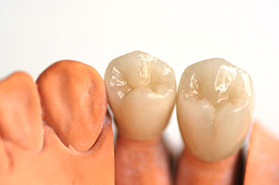 Annadale Dental Crowns or “Caps”