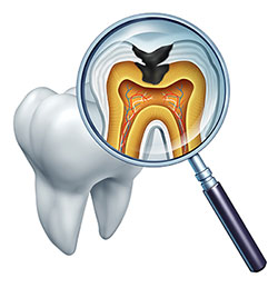 Annadale Tooth Decay