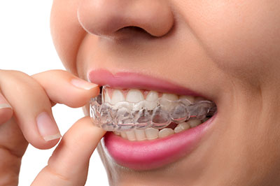 Annadale invisalign