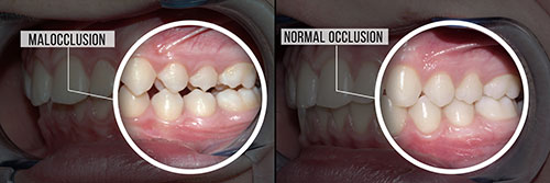 Annadale Malocclusion