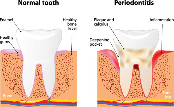 Annadale Periodontal (Gum) Disease