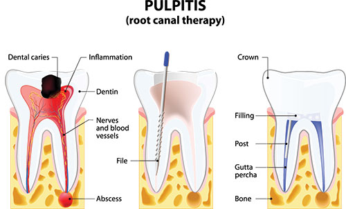 Annadale Dental Crowns or “Caps”