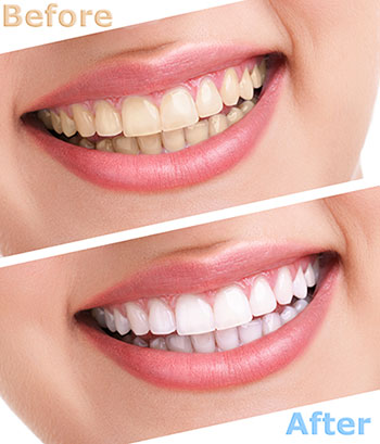 Annadale teeth whitening