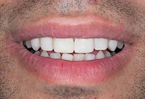 Teeth Whitening in Annadale