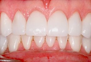 Dental Crowns Annadale