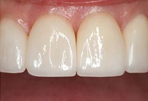 Teeth Whitening Annadale