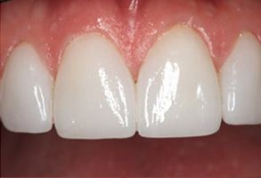 Teeth Whitening Staten Island