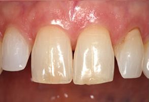 Teeth Whitening Annadale