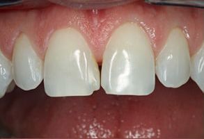 Teeth Whitening Staten Island